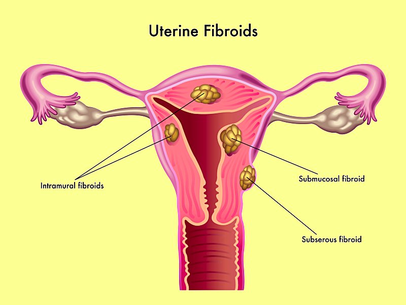 siddha medicine for fibroids